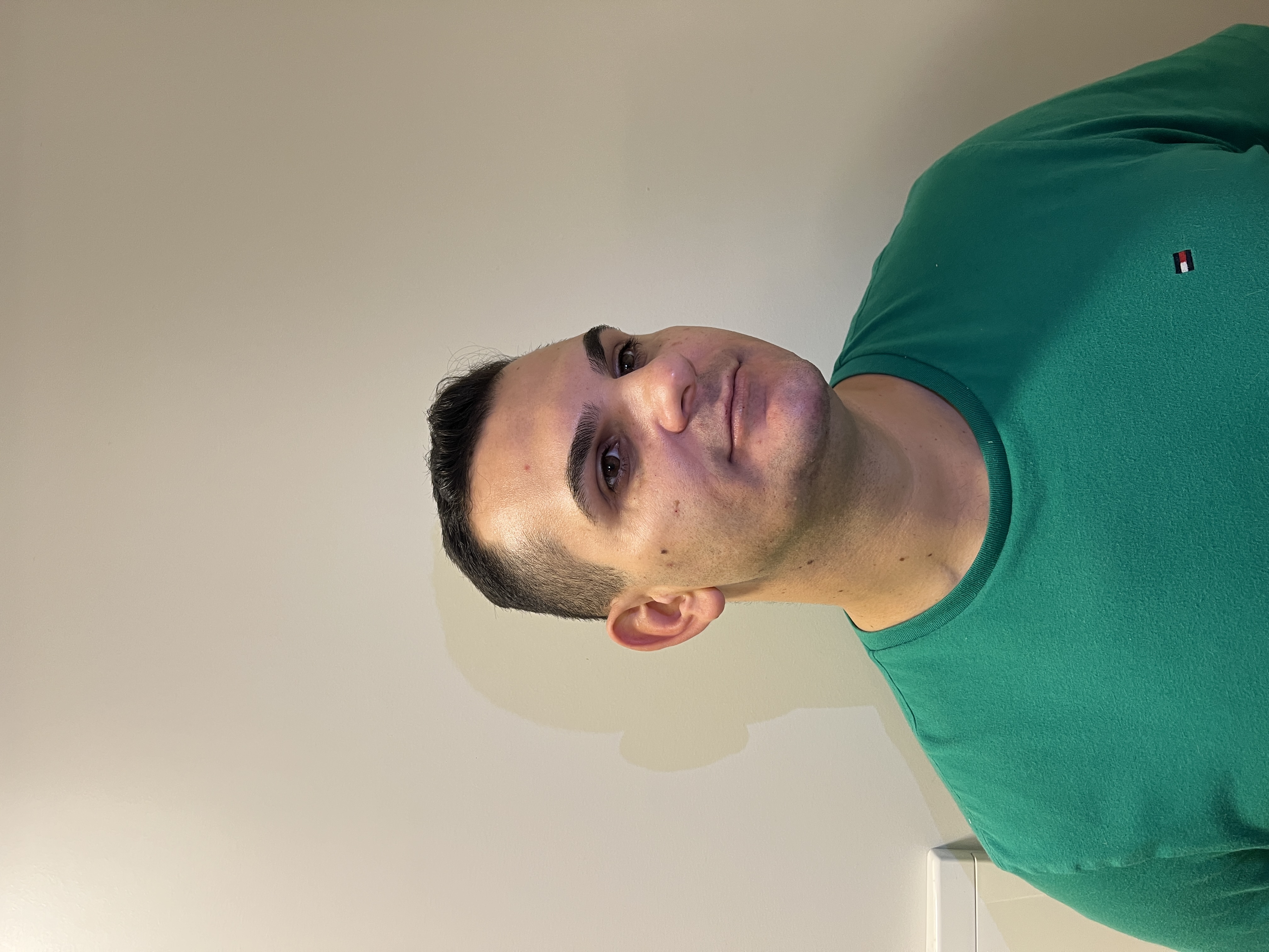 Zéfo depois da harmonização facial - sem barba